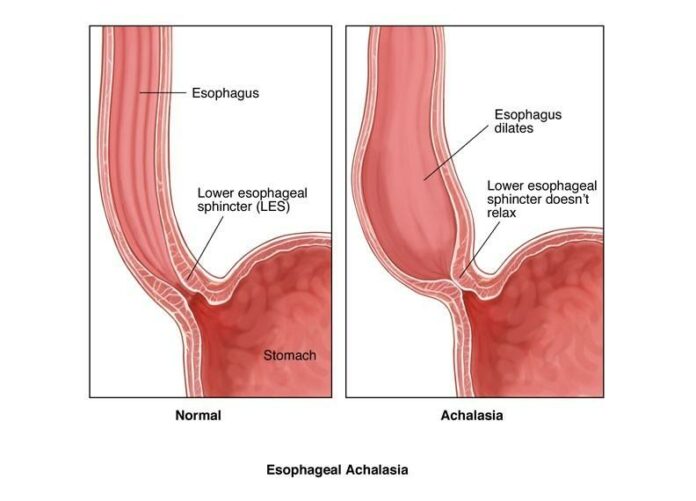 Acalasia esofagea Padova, illustrazione del restringimento che ostacola il passaggio del cibo verso lo stomaco.